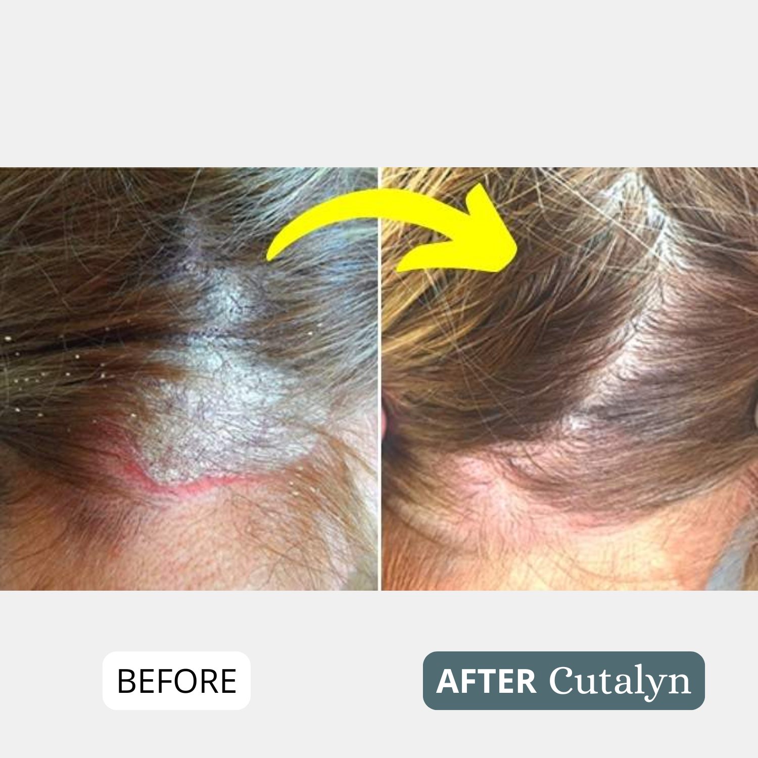 SensiCalm® Soothing Cream ⎜ For a clean, calm & balanced scalp