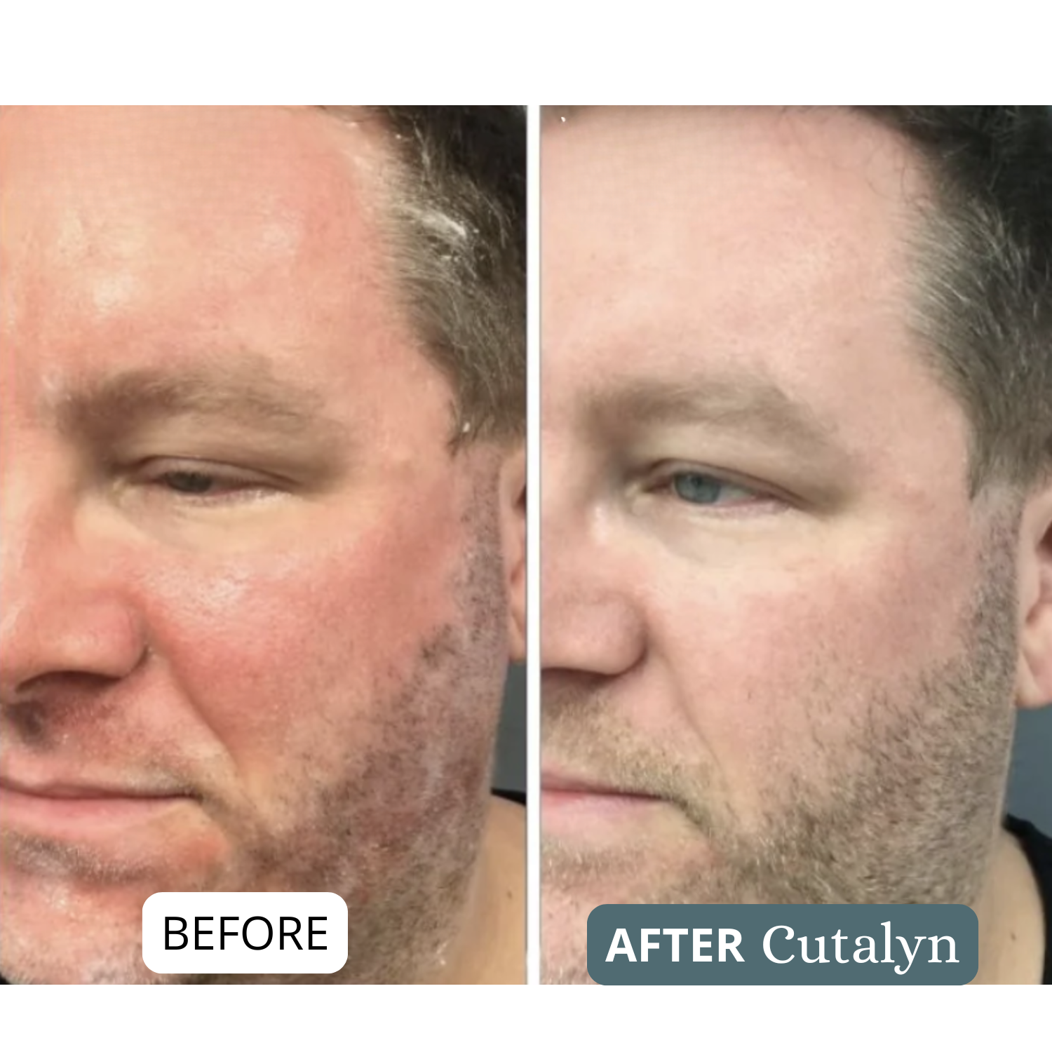 SensiCalm® Cream ⎜ Intensive soothing care for beard and scalp